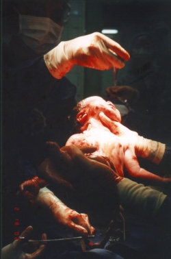 Caesarean Birth